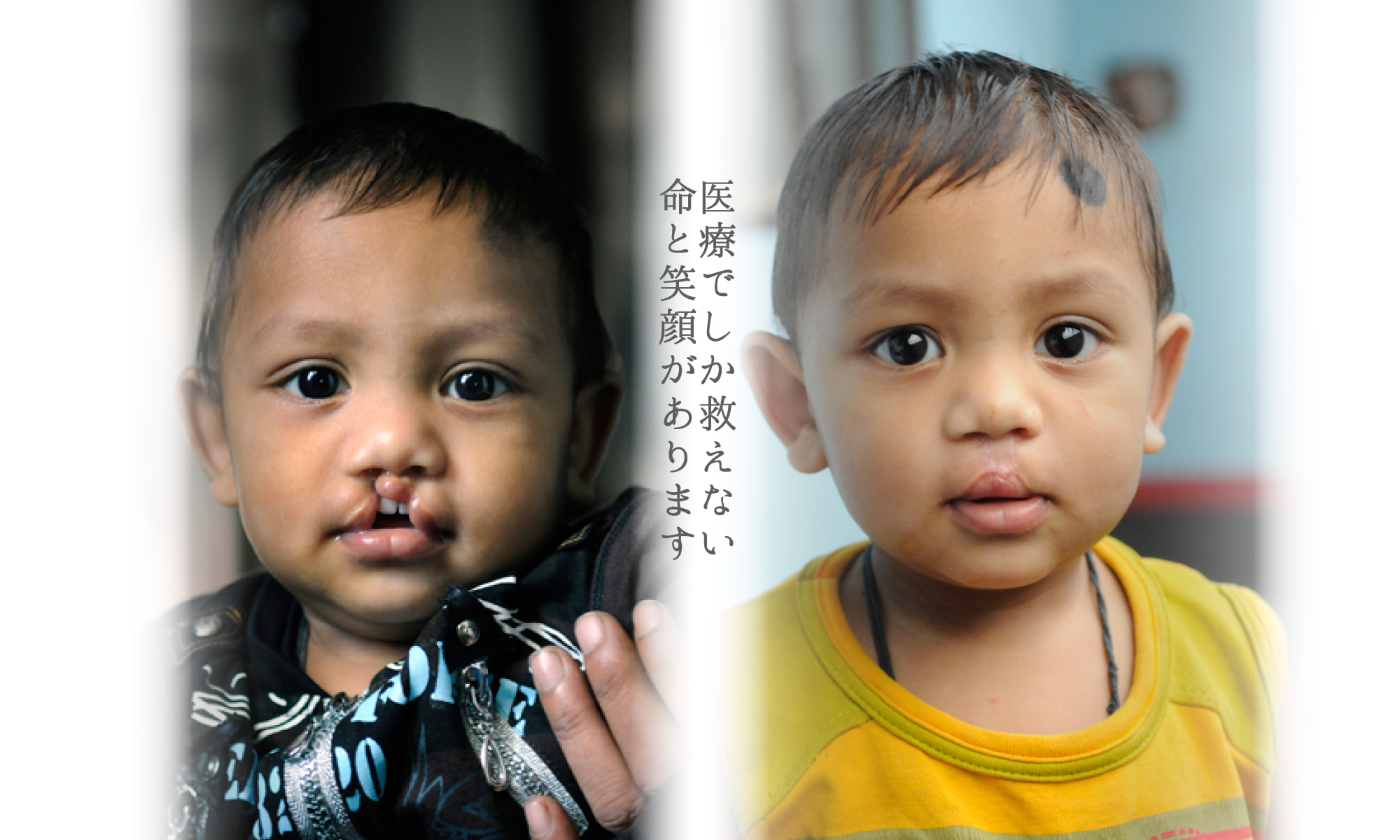 日本の医師たちが、無償で途上国の子ども達に手術を行う「スマイル作戦