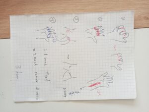 手術の内容をイラストで説明